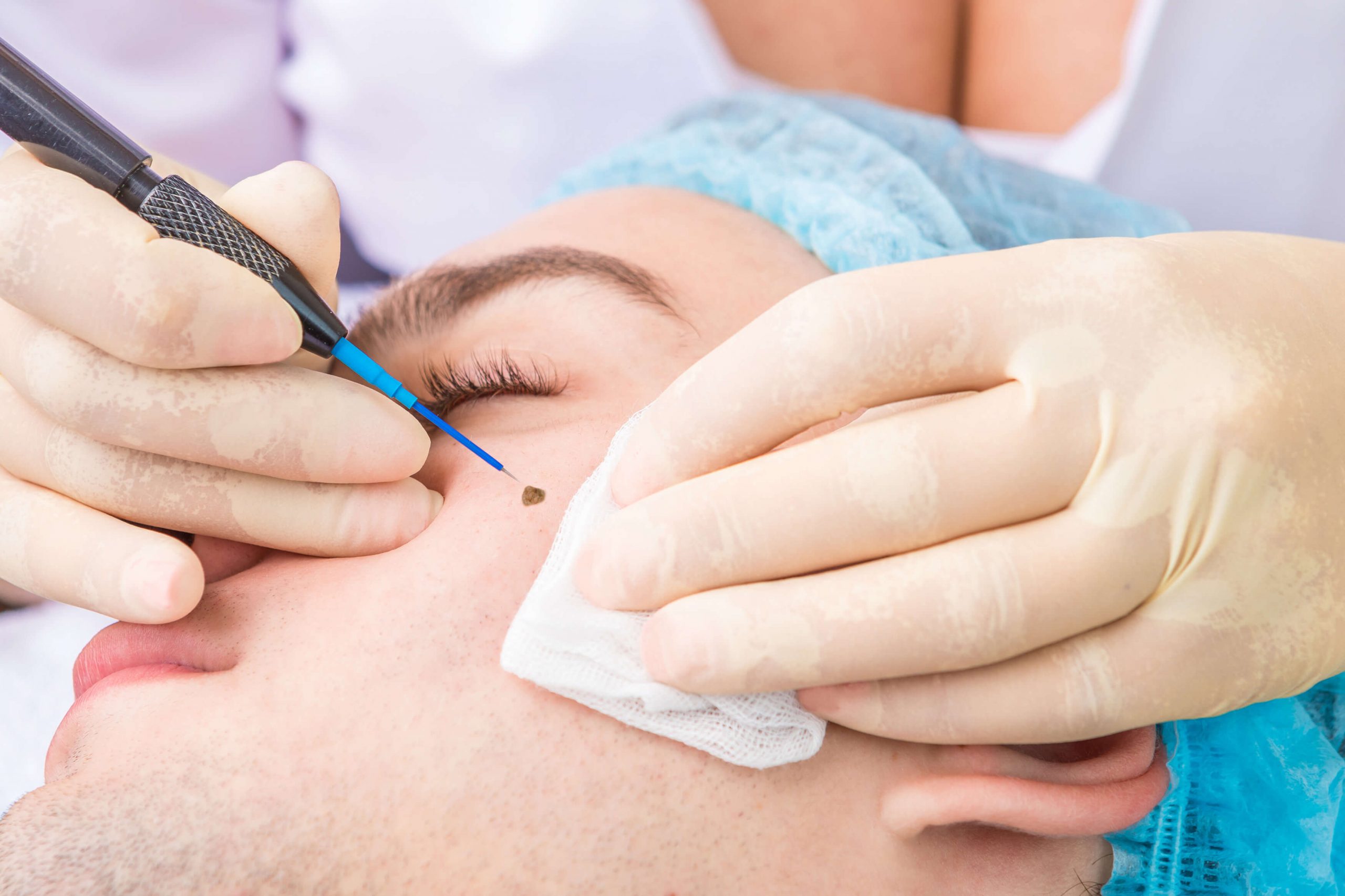 Skin Moles Removal