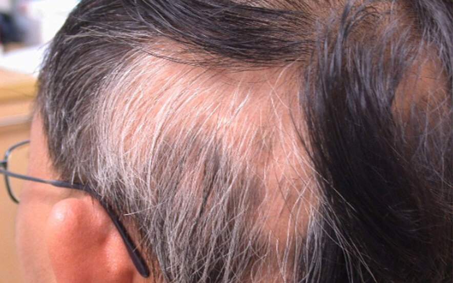 Hair Loss Treatment in Singapore | Various Treatment Options