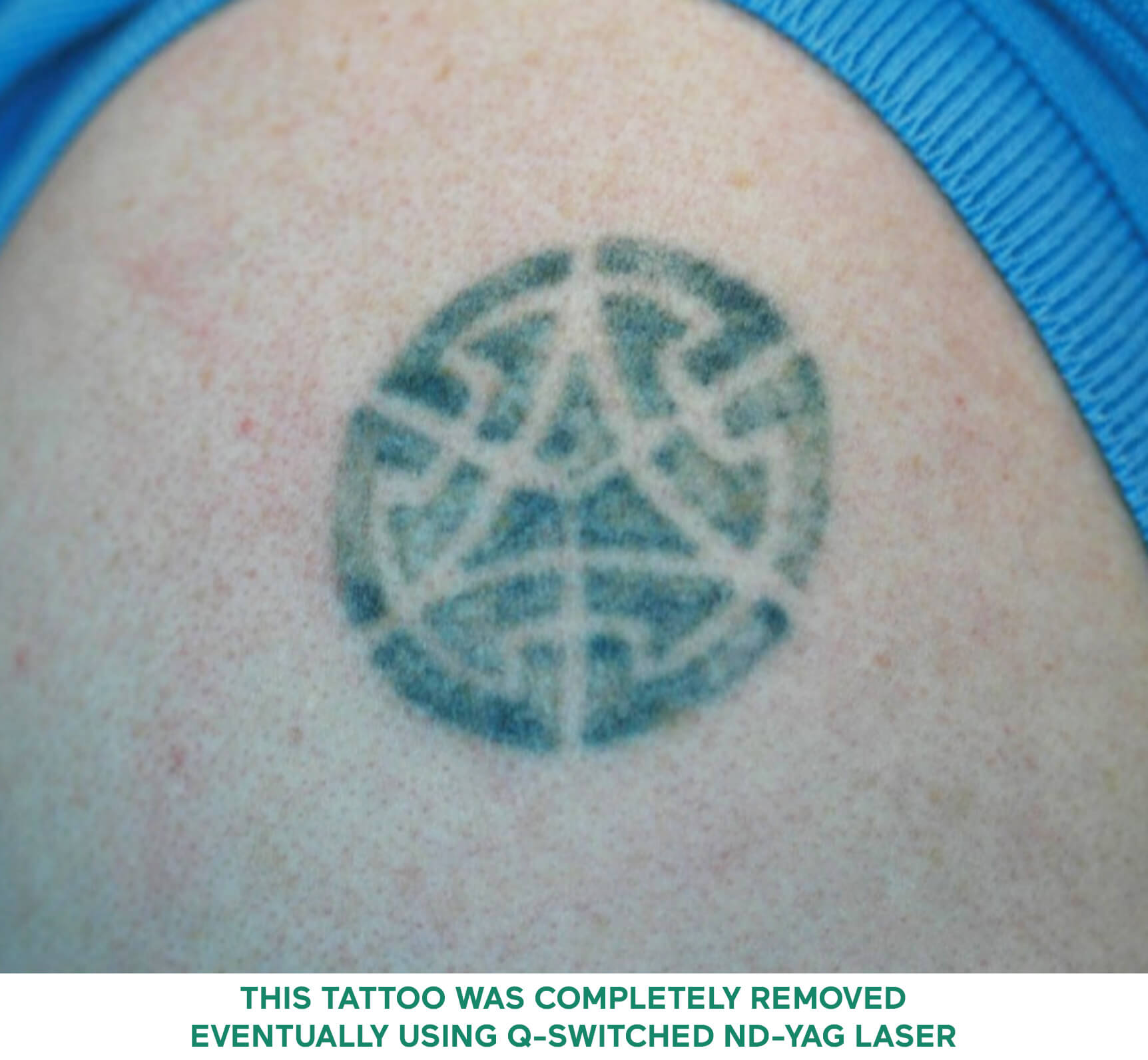 Laser Tattoo Removal Singapore | Dr Wong Soon Tee