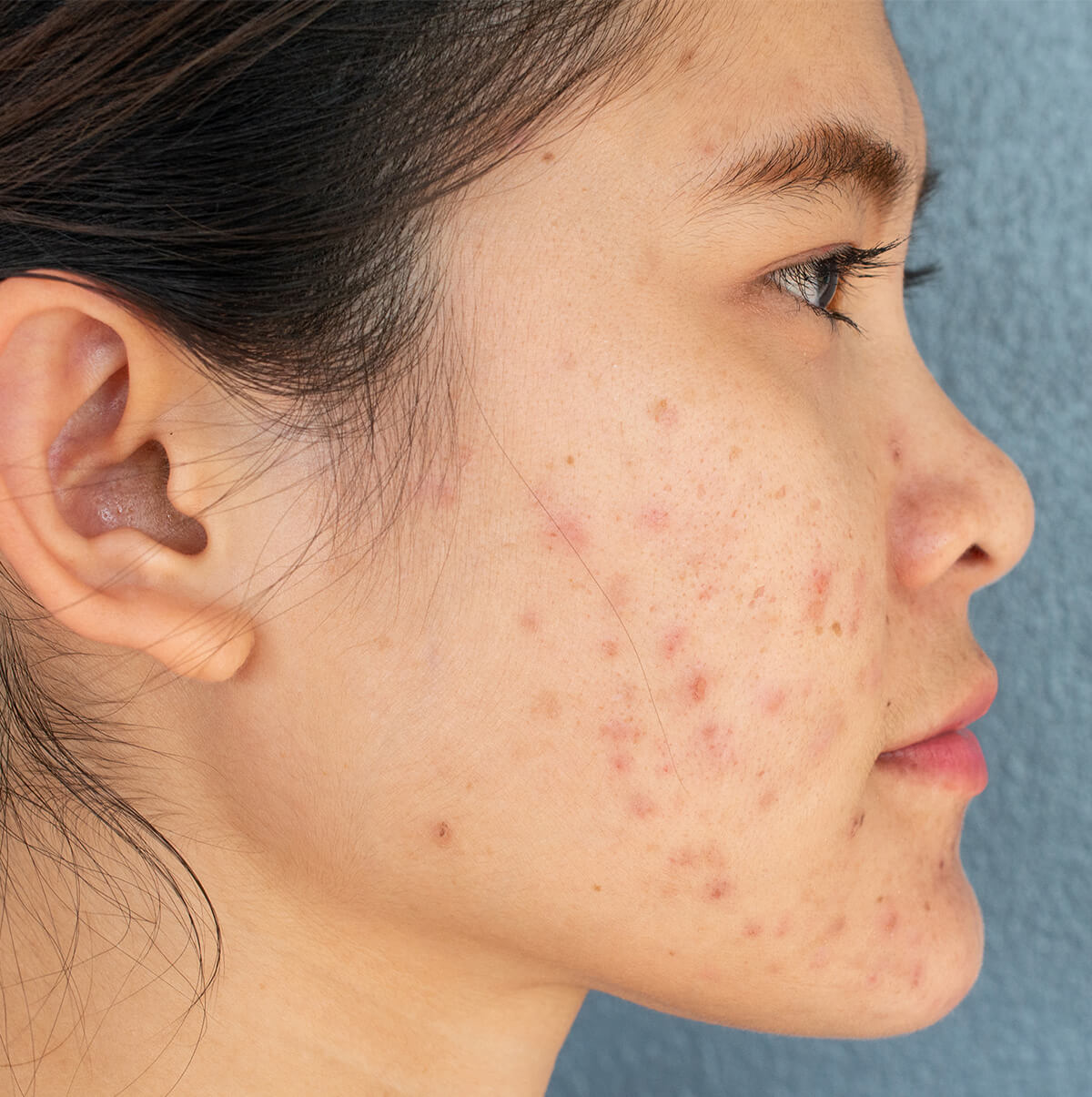 Acne Treatment In Singapore Dermatologist Dr Wong Soon Tee