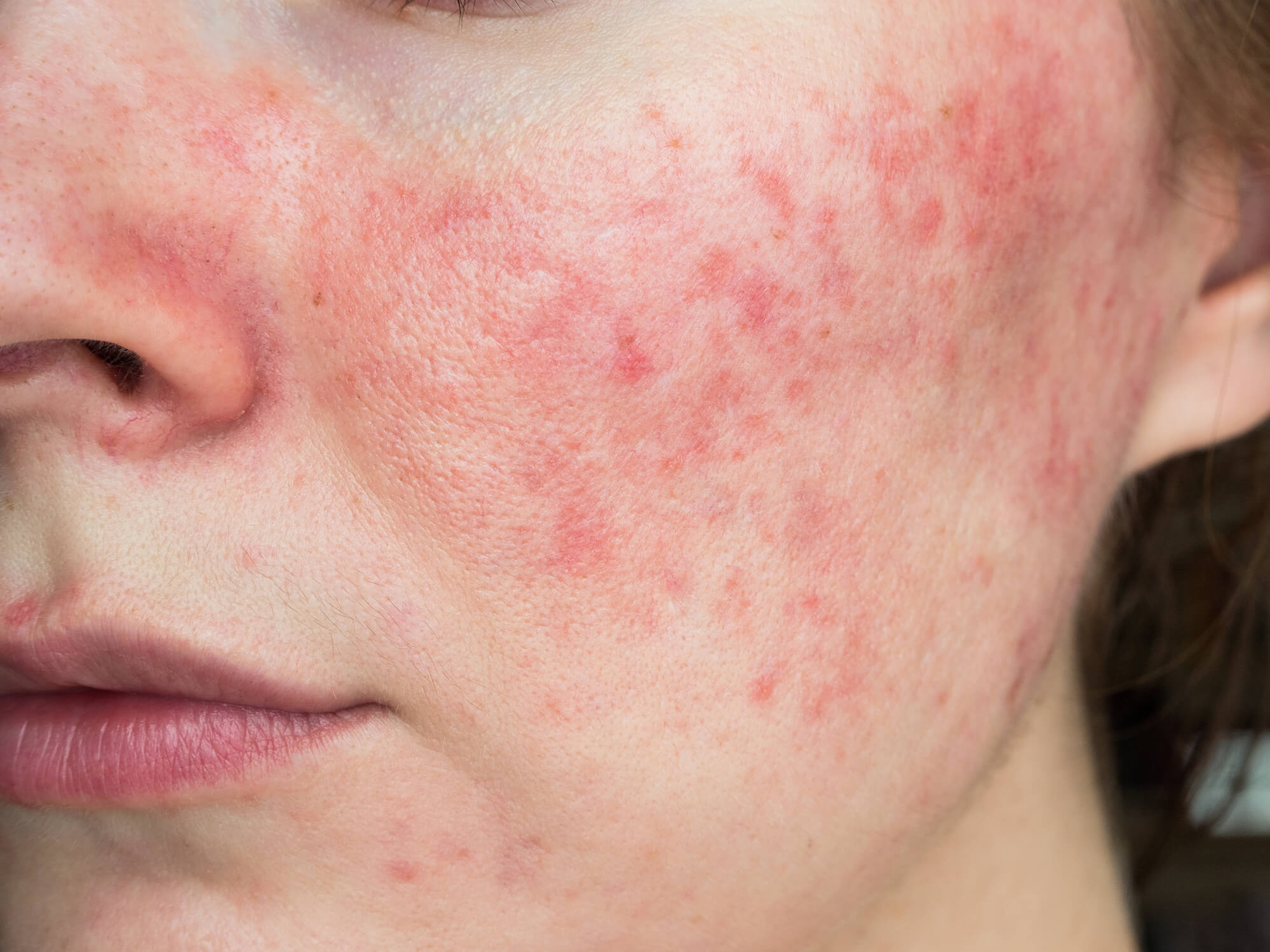 Achieving Lasting Relief: How to Get Rid of Rosacea Permanently with 5 Proven Treatments