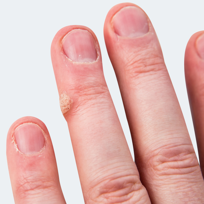 Treatment Of Warts Medscape In Singapore