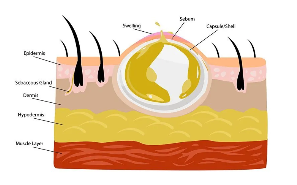 Epidermoid Cyst Removal Singapore